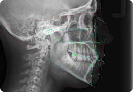Telerradiografía