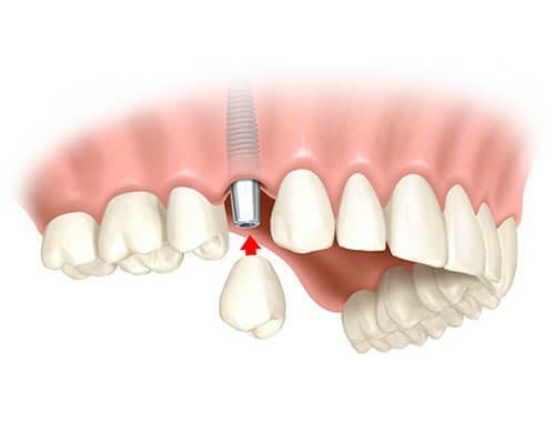 Cirugía e implantología, López Gil clínica dental Villarrobledo