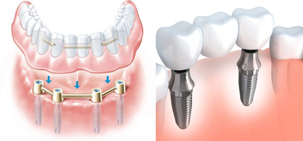 implantología, López Gil clínica dental Villarrobledo
