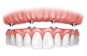 implantología, López Gil clínica dental Villarrobledo