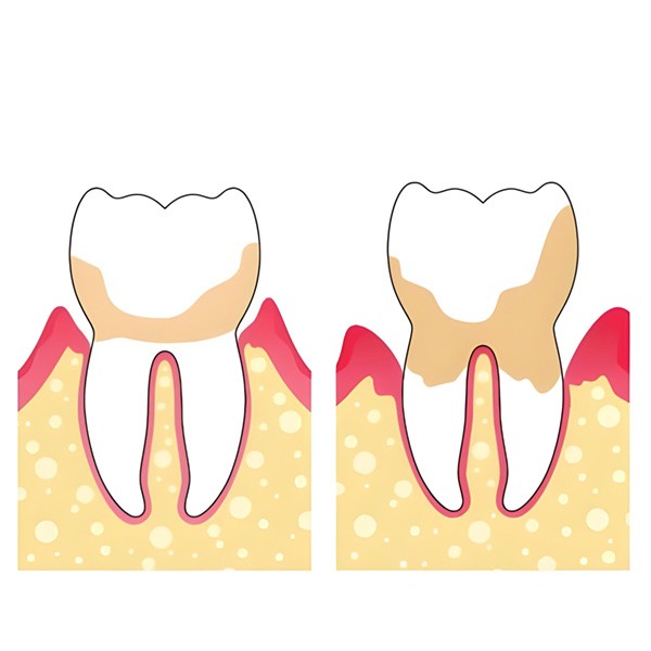 Periodontitis, López Gil clínica dental Villarrobledo