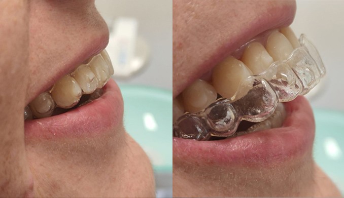Proveedor oficial Invisalign, Clínica Dental Lopez Gil