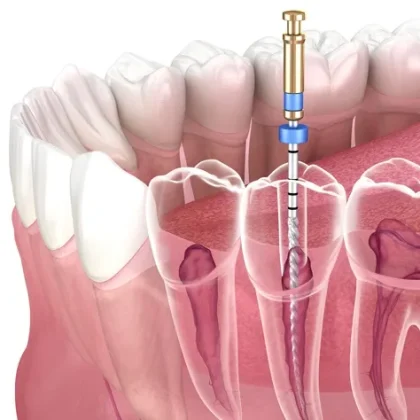 Endodoncia, López Gil clínica dental Villarrobledo